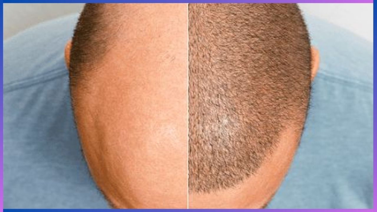 Hair Transplant: ಕೂದಲು ಉದುರುವ ಸಮಸ್ಯೆಗೊಂದು ಶಾಶ್ವತ ಪರಿಹಾರ, ಕೂದಲು ಕಸಿ ವಿಧಾನ