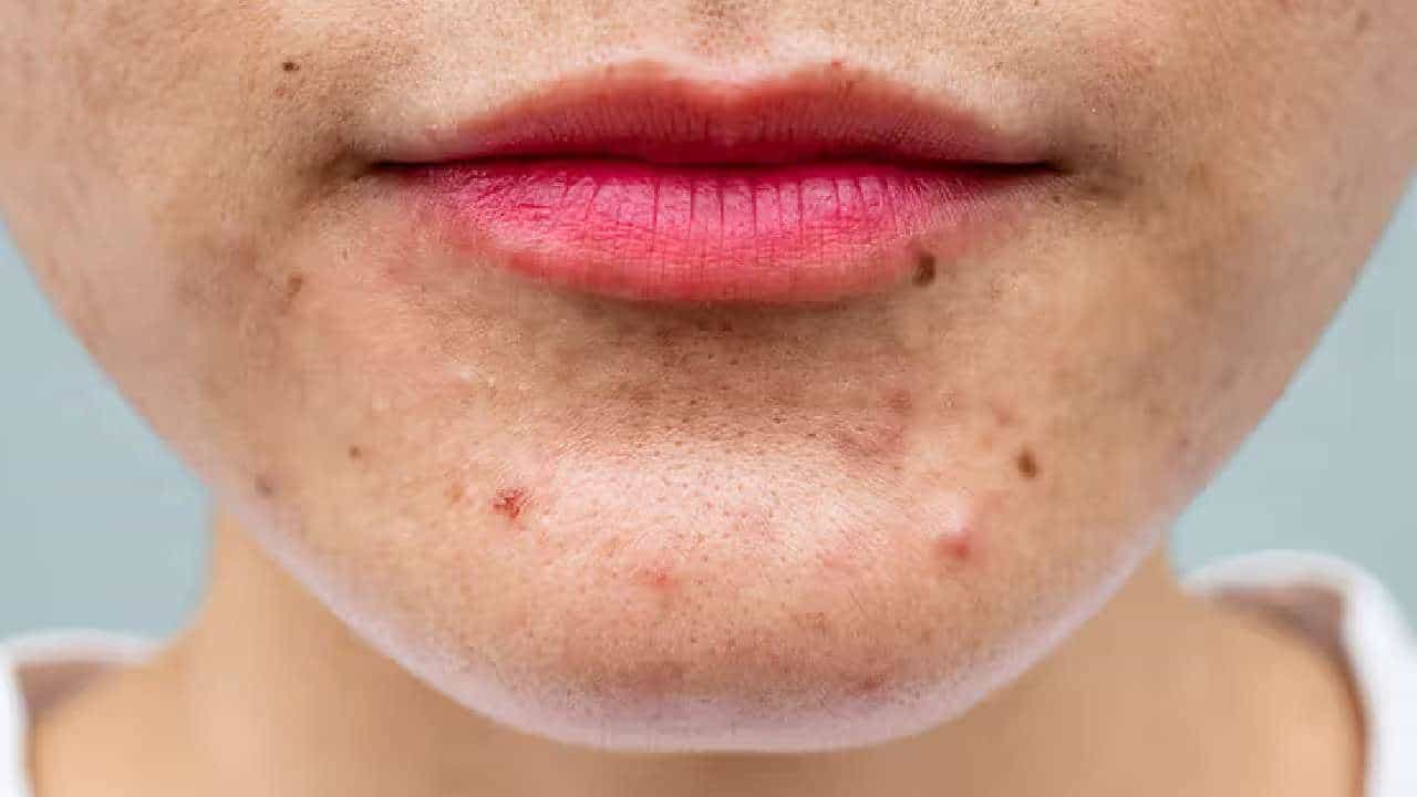 Skin Care: ಈ ಎಲೆಗಳನ್ನು ಹೀಗೆ ಬಳಸಿದರೆ ಮುಖದಲ್ಲಿ ಮೊಡವೆಗಳು ಆಗುವುದಿಲ್ಲ Skin Care: ಈ ಎಲೆಗಳನ್ನು ಹೀಗೆ ಬಳಸಿದರೆ ಮುಖದಲ್ಲಿ ಮೊಡವೆಗಳು ಆಗುವುದಿಲ್ಲ