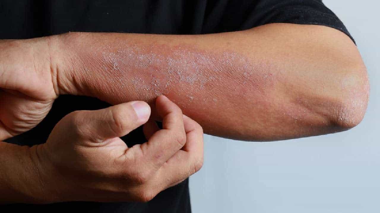 Home remedies: ಚರ್ಮದಲ್ಲಿ ಉಂಟಾಗುವ ತುರಿಕೆಗೆ ಇಲ್ಲಿದೆ ಸರಳ ಮನೆಮದ್ದು Home remedies: ಚರ್ಮದಲ್ಲಿ ಉಂಟಾಗುವ ತುರಿಕೆಗೆ ಇಲ್ಲಿದೆ ಸರಳ ಮನೆಮದ್ದು
