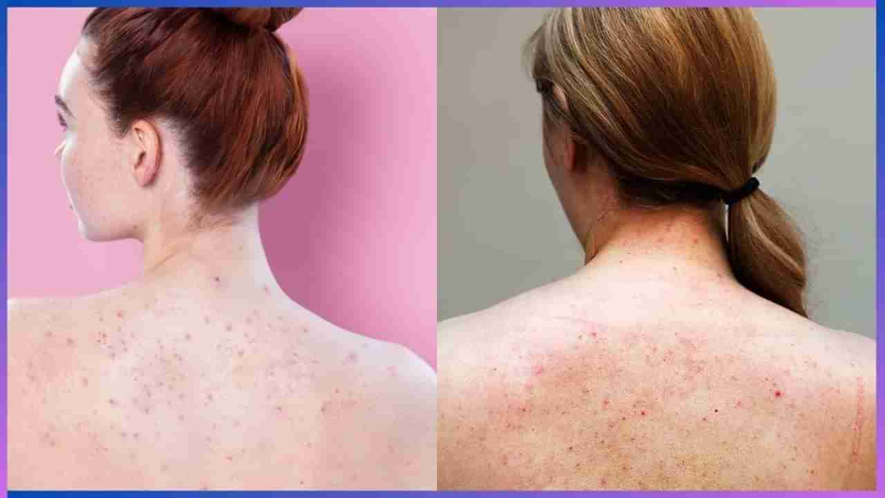 Body Acne : ಬೆನ್ನ ಮೇಲಿನ ಮೊಡವೆಗಳಿಂದ ಕಿರಿಕಿರಿ ಅನುಭವಿಸುತ್ತಿದ್ದೀರಾ? ಇಲ್ಲಿದೆ ಸುಲಭ ಪರಿಹಾರ