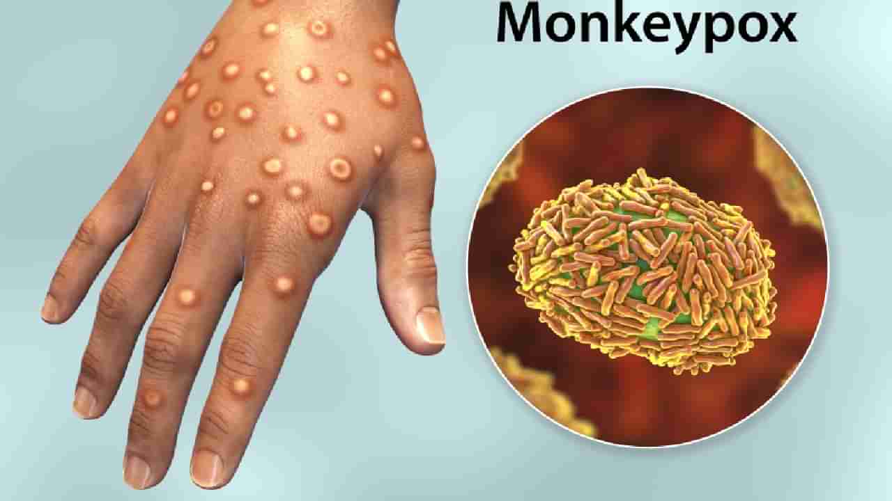 Monkeypox: ಮಂಕಿಪಾಕ್ಸ್ ವೈರಸ್ ಸೋಂಕಿತರ ಚಿಕಿತ್ಸೆಗೆ ದೆಹಲಿ ಏಮ್ಸ್ ಪ್ರೋಟೋಕಾಲ್ ಬಿಡುಗಡೆ