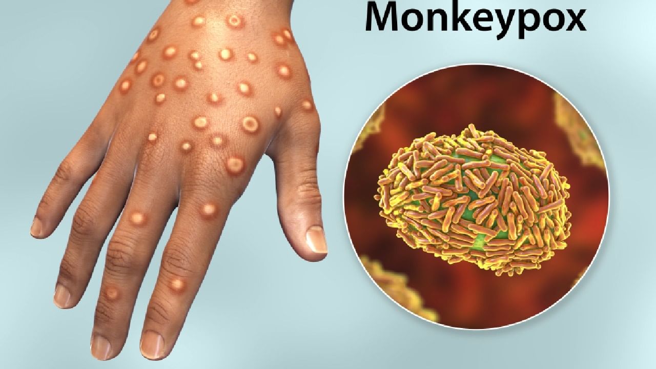 Monkeypox: ಮಂಕಿಪಾಕ್ಸ್ ವೈರಸ್ ಸೋಂಕಿತರ ಚಿಕಿತ್ಸೆಗೆ ದೆಹಲಿ ಏಮ್ಸ್ ಪ್ರೋಟೋಕಾಲ್ ಬಿಡುಗಡೆ