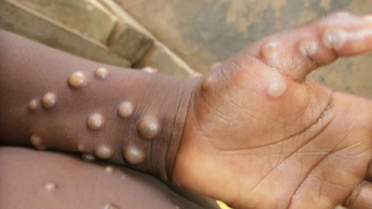 Monkeypox: ಮಂಕಿಪಾಕ್ಸ್ ವೈರಸ್ನ ರೋಗಲಕ್ಷಣಗಳ ಬಗ್ಗೆ ಇಲ್ಲಿದೆ ಮಾಹಿತಿ