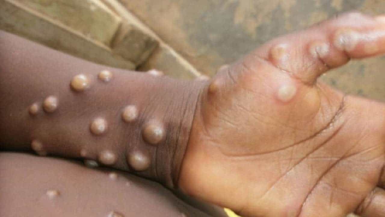 Monkeypox: ಮಂಕಿಪಾಕ್ಸ್ ವೈರಸ್ನ ರೋಗಲಕ್ಷಣಗಳ ಬಗ್ಗೆ ಇಲ್ಲಿದೆ ಮಾಹಿತಿ Monkeypox: ಮಂಕಿಪಾಕ್ಸ್ ವೈರಸ್ನ ರೋಗಲಕ್ಷಣಗಳ ಬಗ್ಗೆ ಇಲ್ಲಿದೆ ಮಾಹಿತಿ