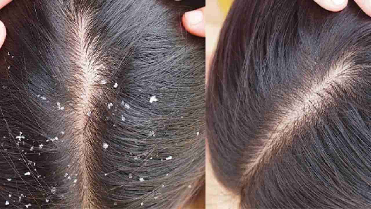 Dandruff: ತಲೆಹೊಟ್ಟಿಗೆ ಕಾರಣವೇನು ? ಸಮಸ್ಯೆ ನಿವಾರಿಸುವುದು ಹೇಗೆ ?