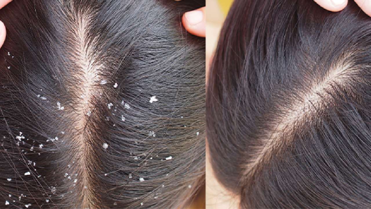 Dandruff: ತಲೆಹೊಟ್ಟಿಗೆ ಕಾರಣವೇನು ? ಸಮಸ್ಯೆ ನಿವಾರಿಸುವುದು ಹೇಗೆ ? Dandruff: ತಲೆಹೊಟ್ಟಿಗೆ ಕಾರಣವೇನು ? ಸಮಸ್ಯೆ ನಿವಾರಿಸುವುದು ಹೇಗೆ ?