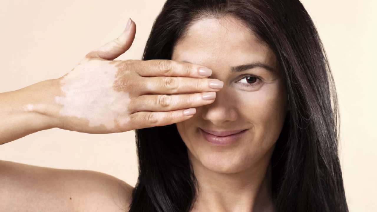 Skin Care Tips: ಈ ಎರಡು ಜೀವಸತ್ವಗಳ ಕೊರತೆಯು ಮೈಬಣ್ಣದಲ್ಲಿ ಬದಲಾವಣೆಗೆ ಕಾರಣವಾಗುತ್ತದೆ