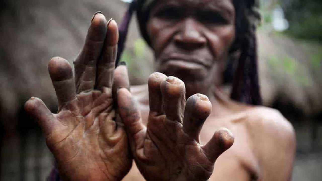 Dani Tribe: ವಿಚಿತ್ರ ಸಂಪ್ರದಾಯ; ಸಂಬಂಧಿ ಸತ್ತರೆ, ಆ ಕುಟುಂಬದ ಮಹಿಳೆ ತನ್ನ ಬೆರಳನ್ನು ಕತ್ತರಿಸಬೇಕು Dani Tribe: ವಿಚಿತ್ರ ಸಂಪ್ರದಾಯ; ಸಂಬಂಧಿ ಸತ್ತರೆ, ಆ ಕುಟುಂಬದ ಮಹಿಳೆ ತನ್ನ ಬೆರಳನ್ನು ಕತ್ತರಿಸಬೇಕು