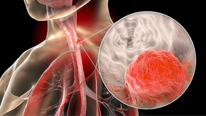 Esophageal Cancer: ಆಗಾಗ ಶೀತವಾಗಿ, ಗಂಟಲು ನೋವು ಕಾಡುತ್ತಿದೆಯೇ? ಈ ಕ್ಯಾನ್ಸರ್ ಆಗಿರಬಹುದು ಎಚ್ಚರ