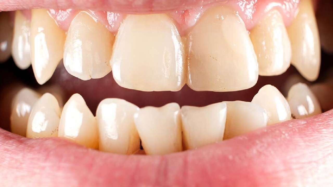 Yellow Teeth: ನಿಮ್ಮ ಹಲ್ಲನ್ನು ಹಳದಿಗೊಳಿಸುವ ಆಹಾರಗಳಿವು