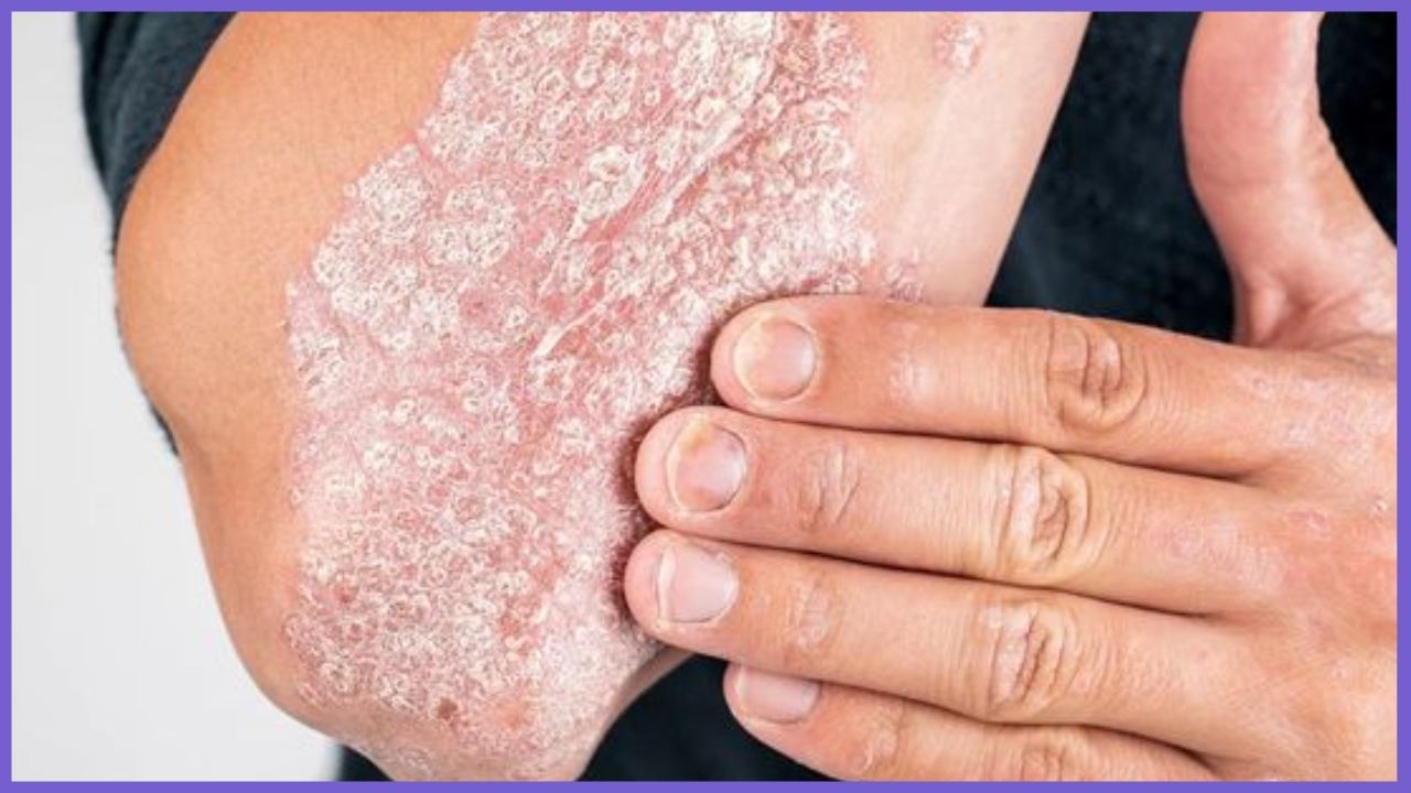 World Psoriasis Day 2024: ಸೋರಿಯಾಸಿಸ್ ಸಮಸ್ಯೆಗೆ ಕಾರಣವೇನು? ಇದರಿಂದ ಮುಕ್ತಿ ಪಡೆಯುವುದು ಹೇಗೆ? World Psoriasis Day 2024: ಸೋರಿಯಾಸಿಸ್ ಸಮಸ್ಯೆಗೆ ಕಾರಣವೇನು? ಇದರಿಂದ ಮುಕ್ತಿ ಪಡೆಯುವುದು ಹೇಗೆ?