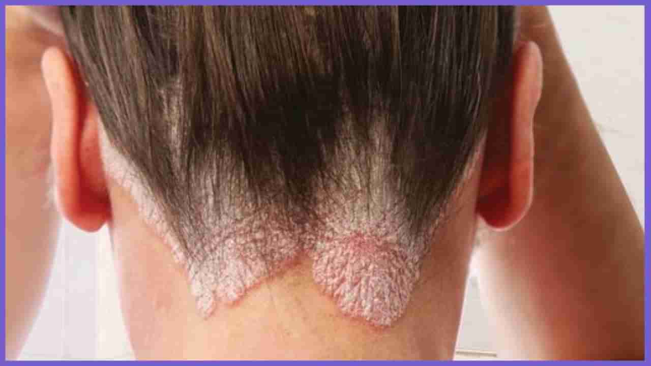 Scalp psoriasis: ನೆತ್ತಿಯಲ್ಲಿ ಕಂಡು ಬರುವ ಸೋರಿಯಾಸಿಸ್ ಸಮಸ್ಯೆಗೆ ತಜ್ಞರು ನೀಡಿರುವ ಕಾರಣಗಳು ಇಲ್ಲಿದೆ