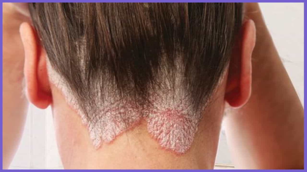 Scalp psoriasis: ನೆತ್ತಿಯಲ್ಲಿ ಕಂಡು ಬರುವ ಸೋರಿಯಾಸಿಸ್ ಸಮಸ್ಯೆಗೆ ತಜ್ಞರು ನೀಡಿರುವ ಕಾರಣಗಳು ಇಲ್ಲಿದೆ Scalp psoriasis: ನೆತ್ತಿಯಲ್ಲಿ ಕಂಡು ಬರುವ ಸೋರಿಯಾಸಿಸ್ ಸಮಸ್ಯೆಗೆ ತಜ್ಞರು ನೀಡಿರುವ ಕಾರಣಗಳು ಇಲ್ಲಿದೆ
