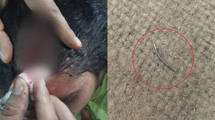 ರೋಗಿಯ ತಲೆಗೆ ಹೊಲಿಗೆ ಹಾಕಿ ಸೂಜಿಯನ್ನು ಅಲ್ಲೇ ಮರೆತ ವೈದ್ಯರು