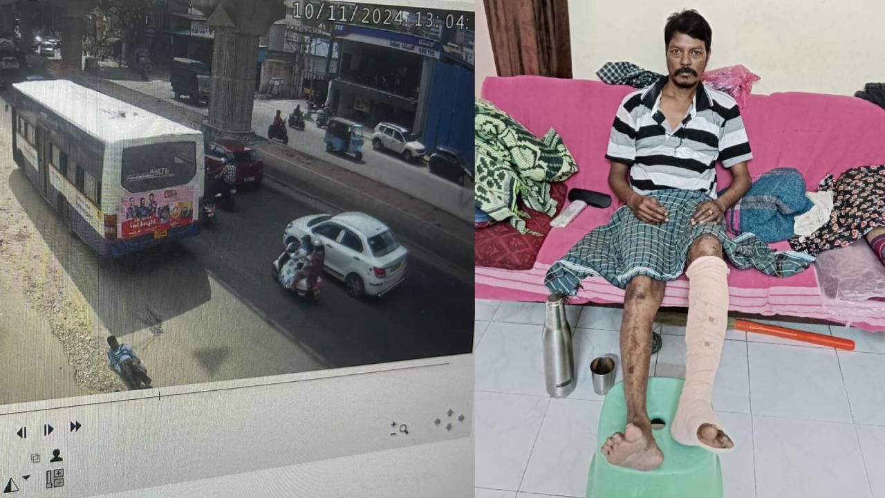 ಬಿಎಂಟಿಸಿ ಬಸ್ ಚಾಲಕನ ನಿರ್ಲಕ್ಷಕ್ಕೆ ಕಾರ್ಮಿಕನ ಕಾಲು ಕಟ್: ಚಿಕಿತ್ಸೆಗೆ ಹಣವಿಲ್ಲದೇ ಪರದಾಟ
