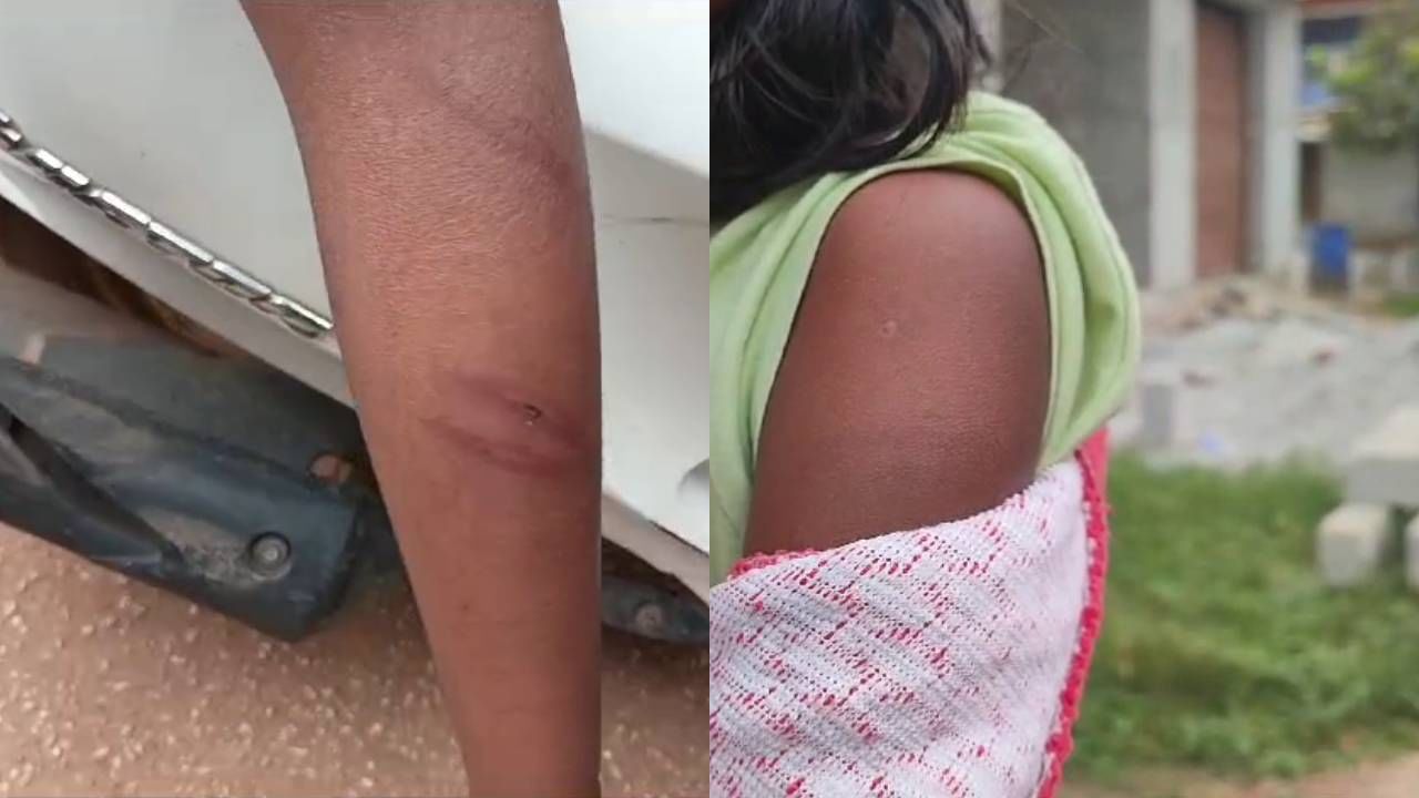 ವಿದ್ಯಾರ್ಥಿನಿಗೆ ಬಾಸುಂಡೆ ಬರುವಂತೆ ಹೊಡೆದ ಪ್ರಾಂಶುಪಾಲೆ, ಪೋಷಕರ ಆಕ್ರೋಶ ವಿದ್ಯಾರ್ಥಿನಿಗೆ ಬಾಸುಂಡೆ ಬರುವಂತೆ ಹೊಡೆದ ಪ್ರಾಂಶುಪಾಲೆ, ಪೋಷಕರ ಆಕ್ರೋಶ