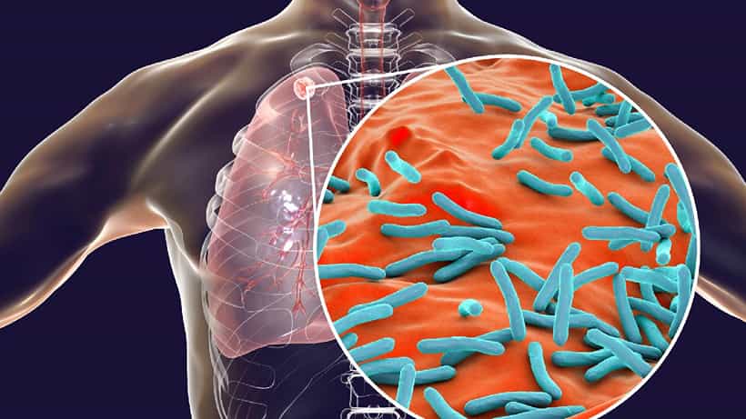 Tuberculosis : ಅತಿ ಹೆಚ್ಚು ಟಿಬಿ ರೋಗಿಗಳನ್ನು ಹೊಂದಿರುವ ರಾಜ್ಯವಿದು