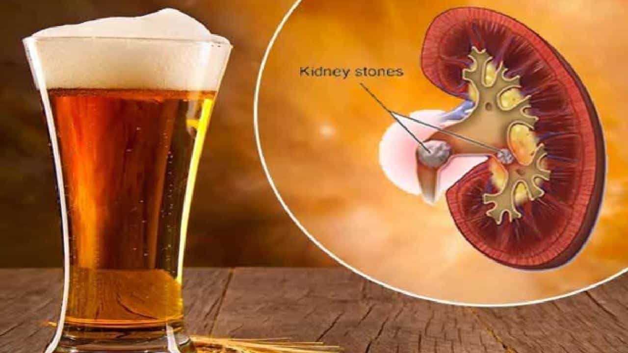ಬಿಯರ್ ಕುಡಿಯುವುದರಿಂದ ಕಿಡ್ನಿ ಸ್ಟೋನ್ ಕರಗುತ್ತದೆಯೇ? ತಜ್ಞರು ಹೇಳುವುದೇನು? ಬಿಯರ್ ಕುಡಿಯುವುದರಿಂದ ಕಿಡ್ನಿ ಸ್ಟೋನ್ ಕರಗುತ್ತದೆಯೇ? ತಜ್ಞರು ಹೇಳುವುದೇನು?