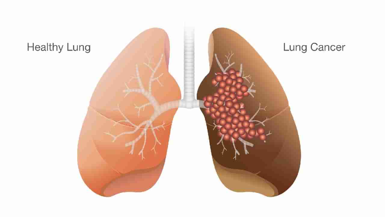 ಶ್ವಾಸಕೋಶದ ಕ್ಯಾನ್ಸರ್ ಮತ್ತು ಗೆಡ್ಡೆಯ ನಡುವಿನ ವ್ಯತ್ಯಾಸವೇನು? ಎರಡರ ಲಕ್ಷಣಗಳನ್ನು ತಿಳಿಯಿರಿ