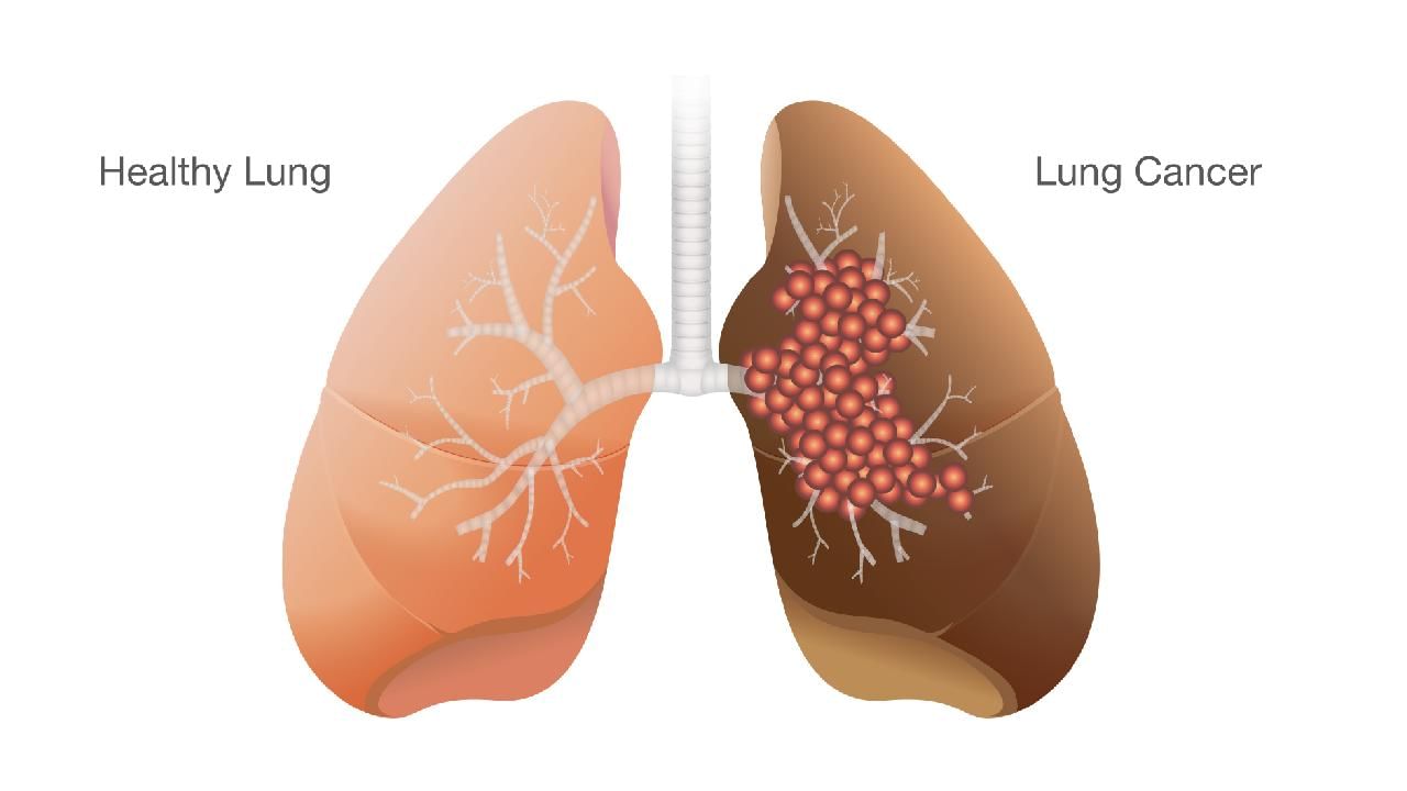 ಶ್ವಾಸಕೋಶದ ಕ್ಯಾನ್ಸರ್ ಮತ್ತು ಗೆಡ್ಡೆಯ ನಡುವಿನ ವ್ಯತ್ಯಾಸವೇನು? ಎರಡರ ಲಕ್ಷಣಗಳನ್ನು ತಿಳಿಯಿರಿ