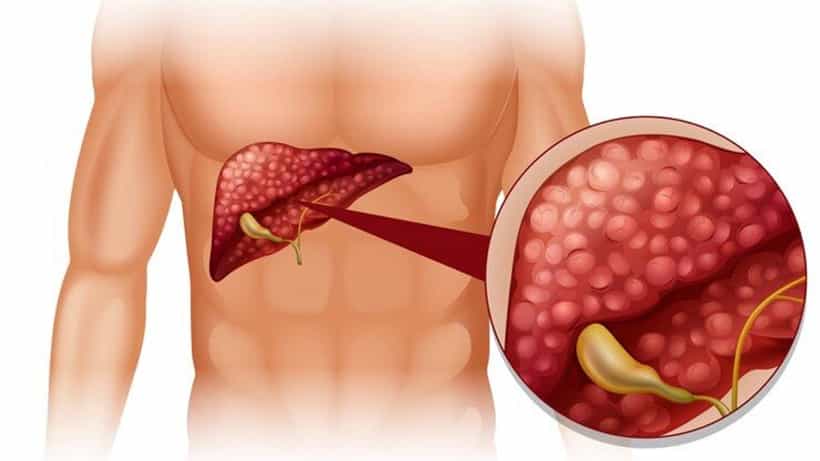 Health News: ದೇಹದಲ್ಲಿ ಕಂಡುಬರುವ ಈ ಬದಲಾವಣೆ ಲಿವರ್ ಕ್ಯಾನ್ಸರ್ನ ಆರಂಭಿಕ ಲಕ್ಷಣ