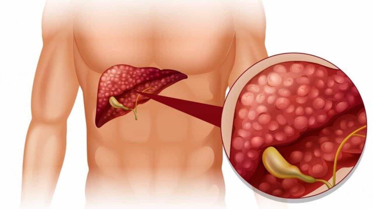 Health News: ದೇಹದಲ್ಲಿ ಕಂಡುಬರುವ ಈ ಬದಲಾವಣೆ ಲಿವರ್​ ಕ್ಯಾನ್ಸರ್​​ನ ಆರಂಭಿಕ ಲಕ್ಷಣ