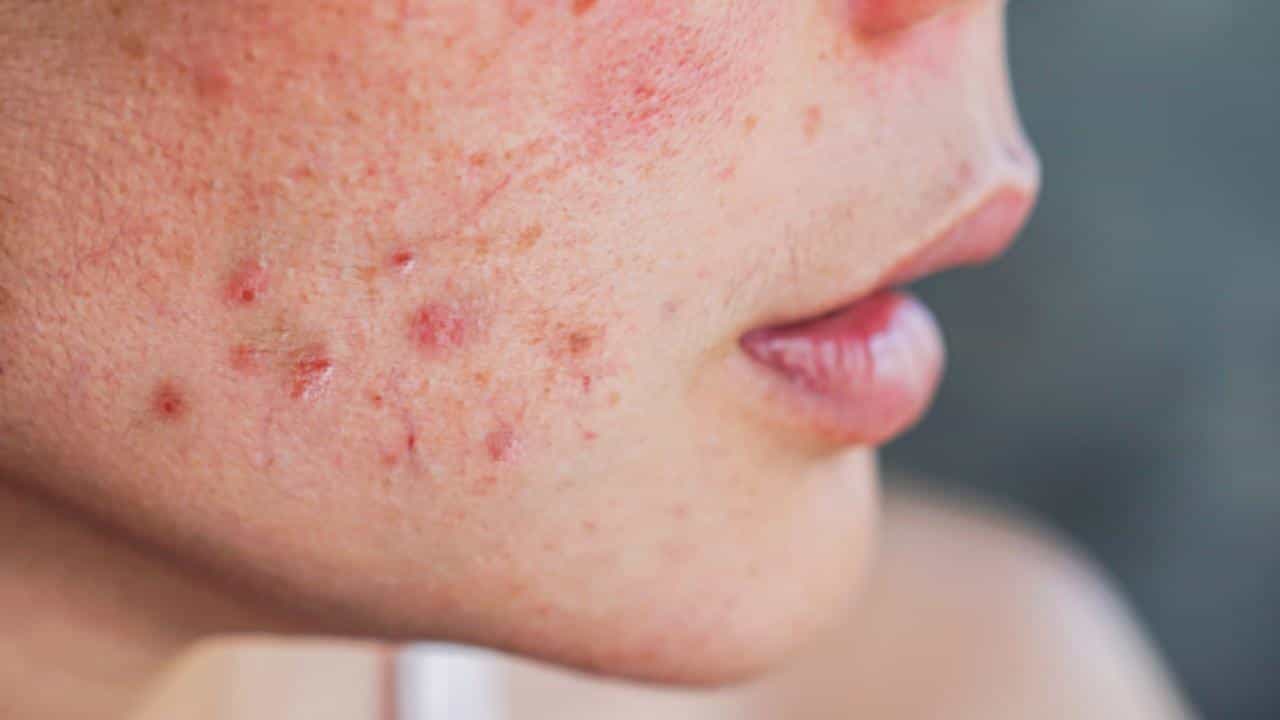 Skincare Tips: ಚಳಿಗಾಲದಲ್ಲಿ ಕಾಣಿಸಿಕೊಳ್ಳುವ ಮೊಡವೆಗಳನ್ನು ತಡೆಯುವುದು ಹೇಗೆ? ಇಲ್ಲಿದೆ ಪರಿಹಾರ Skincare Tips: ಚಳಿಗಾಲದಲ್ಲಿ ಕಾಣಿಸಿಕೊಳ್ಳುವ ಮೊಡವೆಗಳನ್ನು ತಡೆಯುವುದು ಹೇಗೆ? ಇಲ್ಲಿದೆ ಪರಿಹಾರ