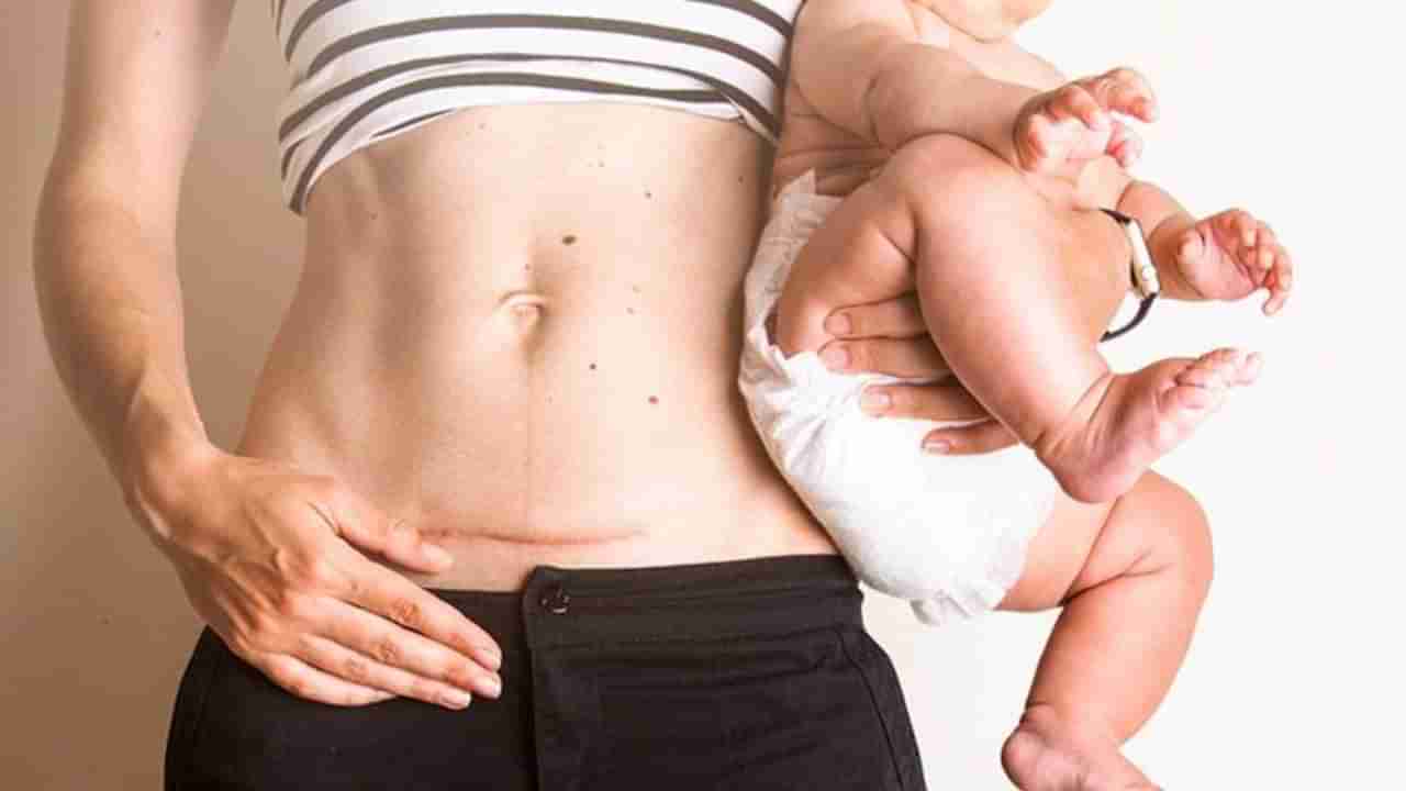 pregnancy tips: ಸಿಸೇರಿಯನ್ ಹೆರಿಗೆಯ ಬಳಿಕ ಬೇಗ ಚೇತರಿಸಿಕೊಳ್ಳಲು ಈ ಆಹಾರಗಳನ್ನು ಸೇವನೆ ಮಾಡಿ