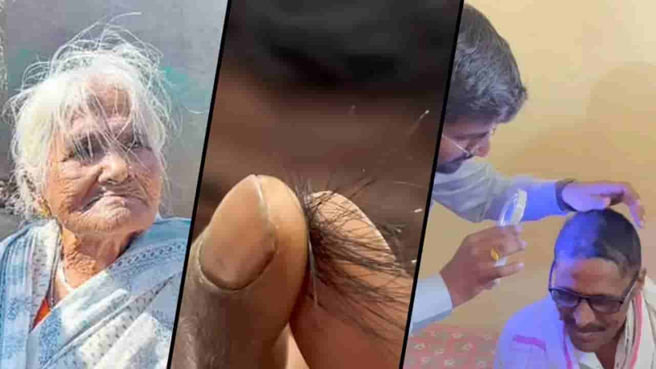 ಮಹಾರಾಷ್ಟ್ರ: ಜನರ ಕೂದಲು ಹಠಾತ್ ಉದುರಿ ಬೋಳಾಗುತ್ತಿದೆ ತಲೆ, ಕಾರಣವೇನು?
