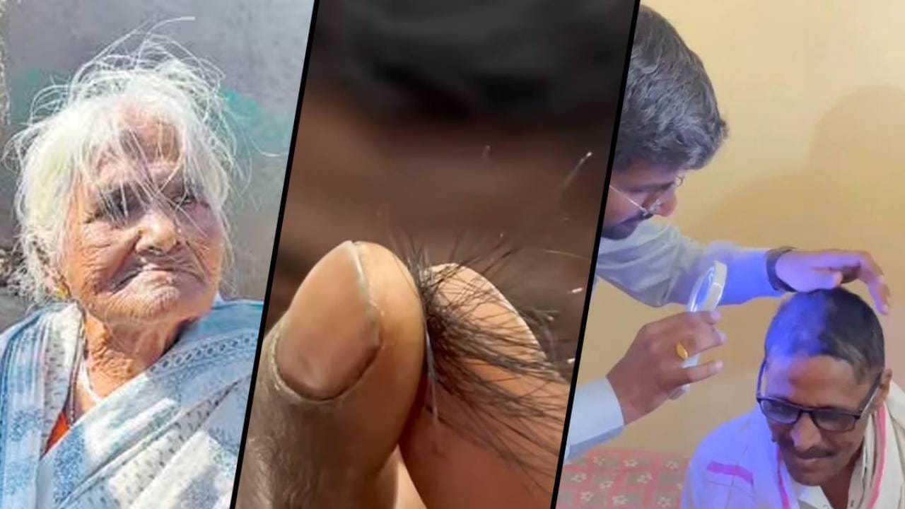 ಮಹಾರಾಷ್ಟ್ರ: ಜನರ ಕೂದಲು ಹಠಾತ್ ಉದುರಿ ಬೋಳಾಗುತ್ತಿದೆ ತಲೆ, ಕಾರಣವೇನು? ಮಹಾರಾಷ್ಟ್ರ: ಜನರ ಕೂದಲು ಹಠಾತ್ ಉದುರಿ ಬೋಳಾಗುತ್ತಿದೆ ತಲೆ, ಕಾರಣವೇನು?