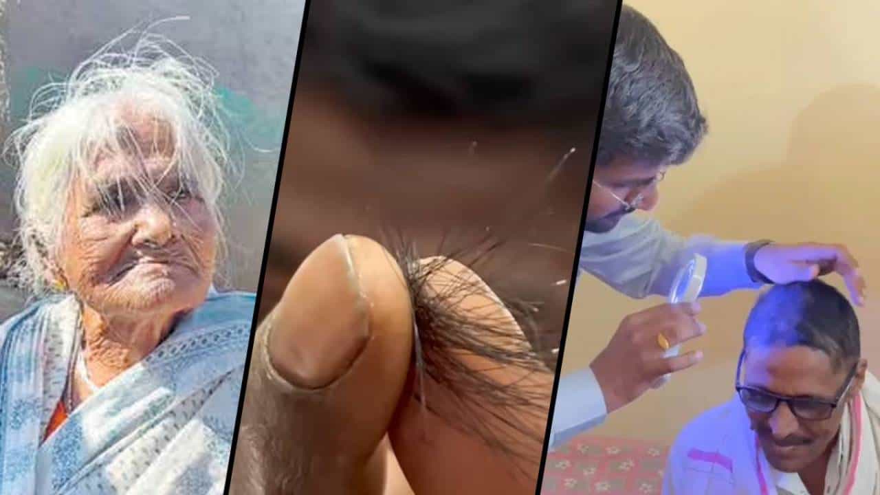 ಮಹಾರಾಷ್ಟ್ರ: ಜನರ ಕೂದಲು ಹಠಾತ್ ಉದುರಿ ಬೋಳಾಗುತ್ತಿದೆ ತಲೆ, ಕಾರಣವೇನು? ಮಹಾರಾಷ್ಟ್ರ: ಜನರ ಕೂದಲು ಹಠಾತ್ ಉದುರಿ ಬೋಳಾಗುತ್ತಿದೆ ತಲೆ, ಕಾರಣವೇನು?