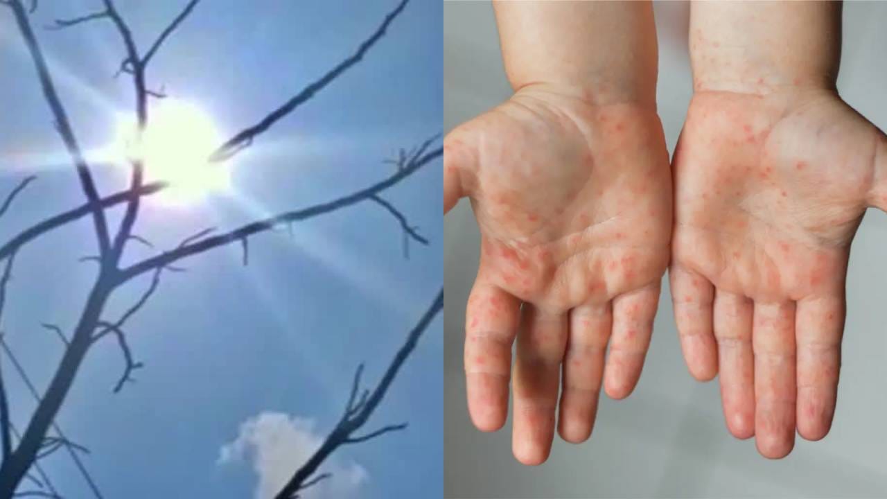 ಬೇಸಿಗೆ ಜೊತೆಗೆ ಮಕ್ಕಳಲ್ಲಿ ಶುರುವಾಯ್ತು ಇನ್ಫೆಕ್ಷನ್ ಹಾವಳಿ: ಪೋಷಕರಿಗೆ ವೈದ್ಯರ ಸಲಹೆ ಏನು? ಬೇಸಿಗೆ ಜೊತೆಗೆ ಮಕ್ಕಳಲ್ಲಿ ಶುರುವಾಯ್ತು ಇನ್ಫೆಕ್ಷನ್ ಹಾವಳಿ: ಪೋಷಕರಿಗೆ ವೈದ್ಯರ ಸಲಹೆ ಏನು?