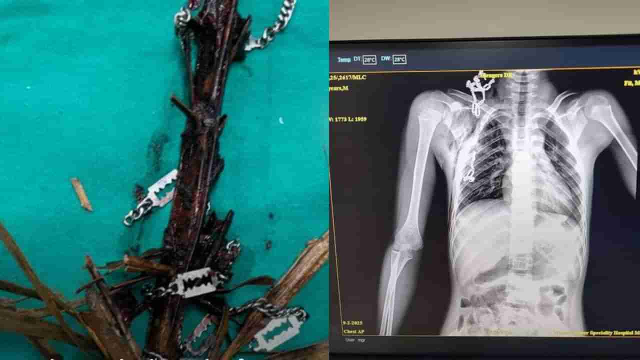 ಬಾಲಕನ ಎದೆಯಾಳಕ್ಕೆ ಹೊಕ್ಕಿದ್ದ ತೆಂಗಿನ ಗರಿ, ಚೈನ್​ ಯಶಸ್ವಿಯಾಗಿ ಹೊರ ತೆಗೆದ ಸರ್ಕಾರಿ ವೈದ್ಯರು