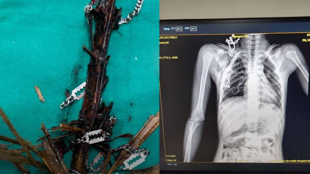 ಬಾಲಕನ ಎದೆಯಾಳಕ್ಕೆ ಹೊಕ್ಕಿದ್ದ ತೆಂಗಿನ ಗರಿ, ಚೈನ್​ ಯಶಸ್ವಿಯಾಗಿ ಹೊರ ತೆಗೆದ ಸರ್ಕಾರಿ ವೈದ್ಯರು