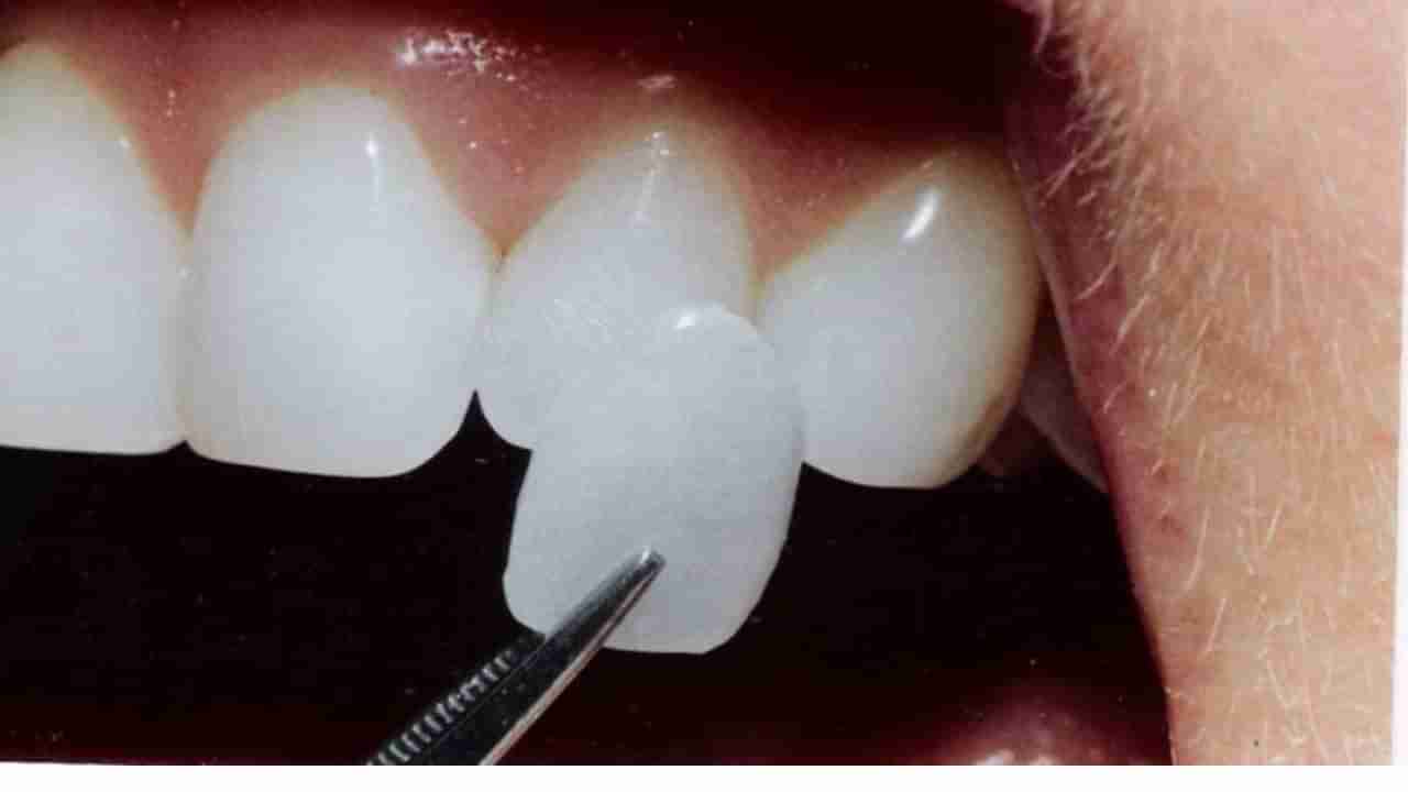 Vitamin deficiency : ಹಲ್ಲು ಚೂರು ಚೂರಾಗಿ ಬೀಳುತ್ತಾ! ಯಾವ ವಿಟಮಿನ್ ಕೊರತೆಯಾಗಿದೆ ತಿಳಿದುಕೊಳ್ಳಿ