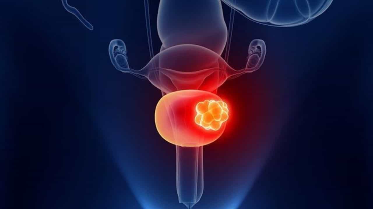 Prostate cancer: ಪುರುಷರೇ, ಈ ರೀತಿಯ ಲಕ್ಷಣಗಳು ಕಂಡು ಬಂದಾಗ ತಕ್ಷಣ ವೈದ್ಯರನ್ನು ಭೇಟಿ ಮಾಡಿ Prostate cancer: ಪುರುಷರೇ, ಈ ರೀತಿಯ ಲಕ್ಷಣಗಳು ಕಂಡು ಬಂದಾಗ ತಕ್ಷಣ ವೈದ್ಯರನ್ನು ಭೇಟಿ ಮಾಡಿ