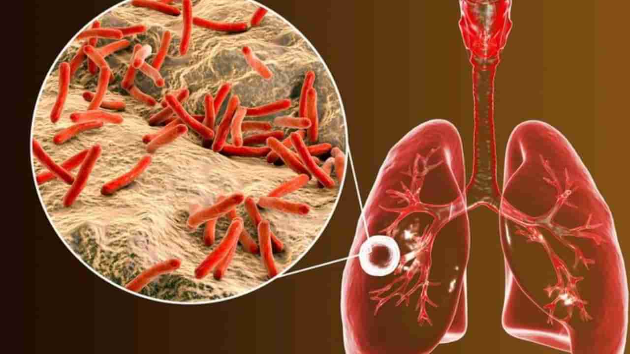 World TB Day 2025: ಟಿಬಿ ಸೋಂಕಿಗೆ ಕಾರಣವೇನು? ಕ್ಷಯರೋಗದ ಬಗ್ಗೆ ಈ ಕೆಲವೊಂದು ಮಾಹಿತಿ ನಿಮಗೆ ಗೊತ್ತಿರಲಿ