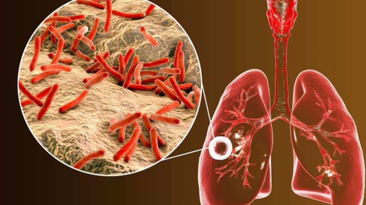 World TB Day 2025: ಟಿಬಿ ಸೋಂಕಿಗೆ ಕಾರಣವೇನು? ಕ್ಷಯರೋಗದ ಬಗ್ಗೆ ಈ ಕೆಲವೊಂದು ಮಾಹಿತಿ ನಿಮಗೆ ಗೊತ್ತಿರಲಿ