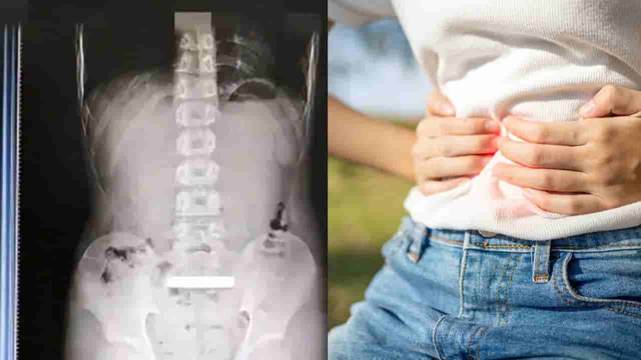 ಹನ್ನೊಂದು ವರ್ಷದ ಬಾಲಕನ ಹೊಟ್ಟೆಯಲ್ಲಿತ್ತು ಚಿನ್ನದ ಗಟ್ಟಿ, ಎಕ್ಸ್ ರೇ ಕಂಡು ಶಾಕ್ ಆದ ವೈದ್ಯರು