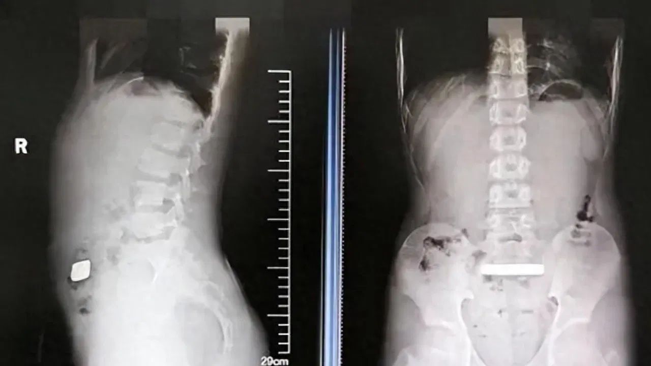 Gold Bar In His Stomach