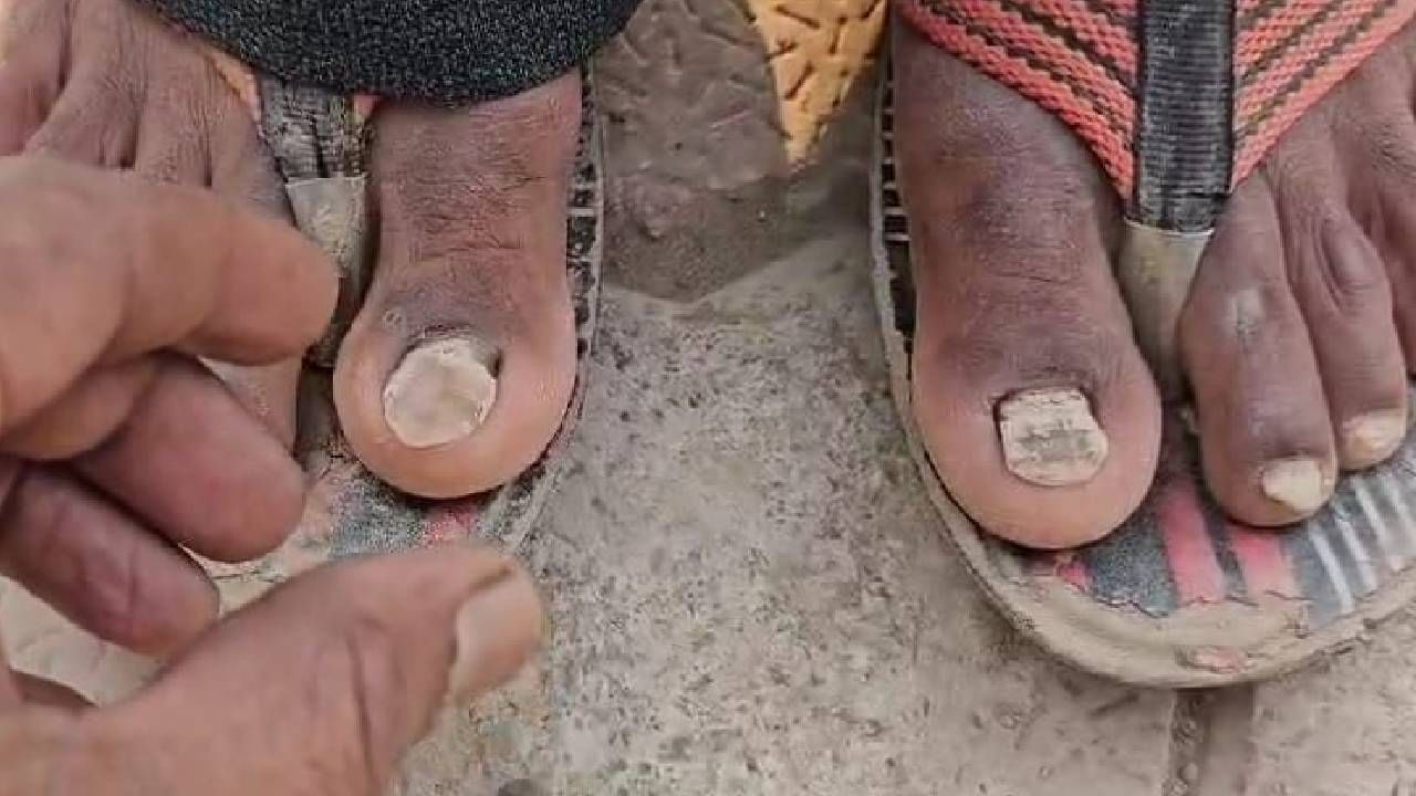 ಕೂದಲು ಉದುರಿಹೋಯ್ತು, ಈಗ ಉಗುರುಗಳನ್ನು ಕಳೆದುಕೊಳ್ಳುತ್ತಿದ್ದಾರೆ ಈ ಜಿಲ್ಲೆಯ ಜನ, ನಿಗೂಢ ಕಾಯಿಲೆ