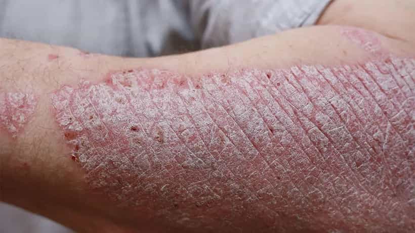 Psoriasis treatment: ಸೋರಿಯಾಸಿಸ್ ಕಾಯಿಲೆ ಹೇಗೆ ಬರುತ್ತೆ? ಪತಂಜಲಿ ಔಷಧಿಗಳಿಂದ ಸೈಡ್ ಎಫೆಕ್ಟ್ಸ್ ಇಲ್ಲದೇ ಚಿಕಿತ್ಸೆ