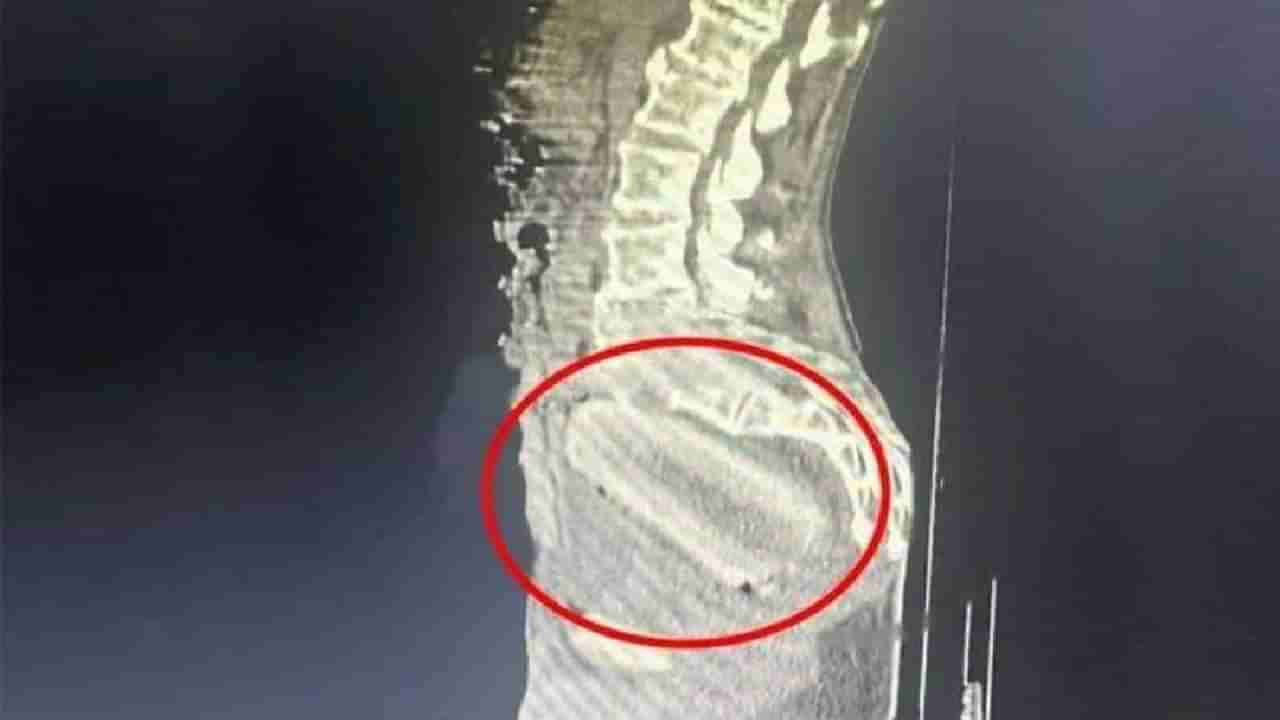 Viral: ಗುದದ್ವಾರದೊಳಗೆ ಮರಗೆಣಸು ತುರುಕಿದ 72 ಹರೆಯದ ಮುದುಕ; ಎಕ್ಸ್-ರೇ ರಿಪೋರ್ಟ್ ಕಂಡು ಶಾಕ್ ಆದ ವೈದ್ಯರು