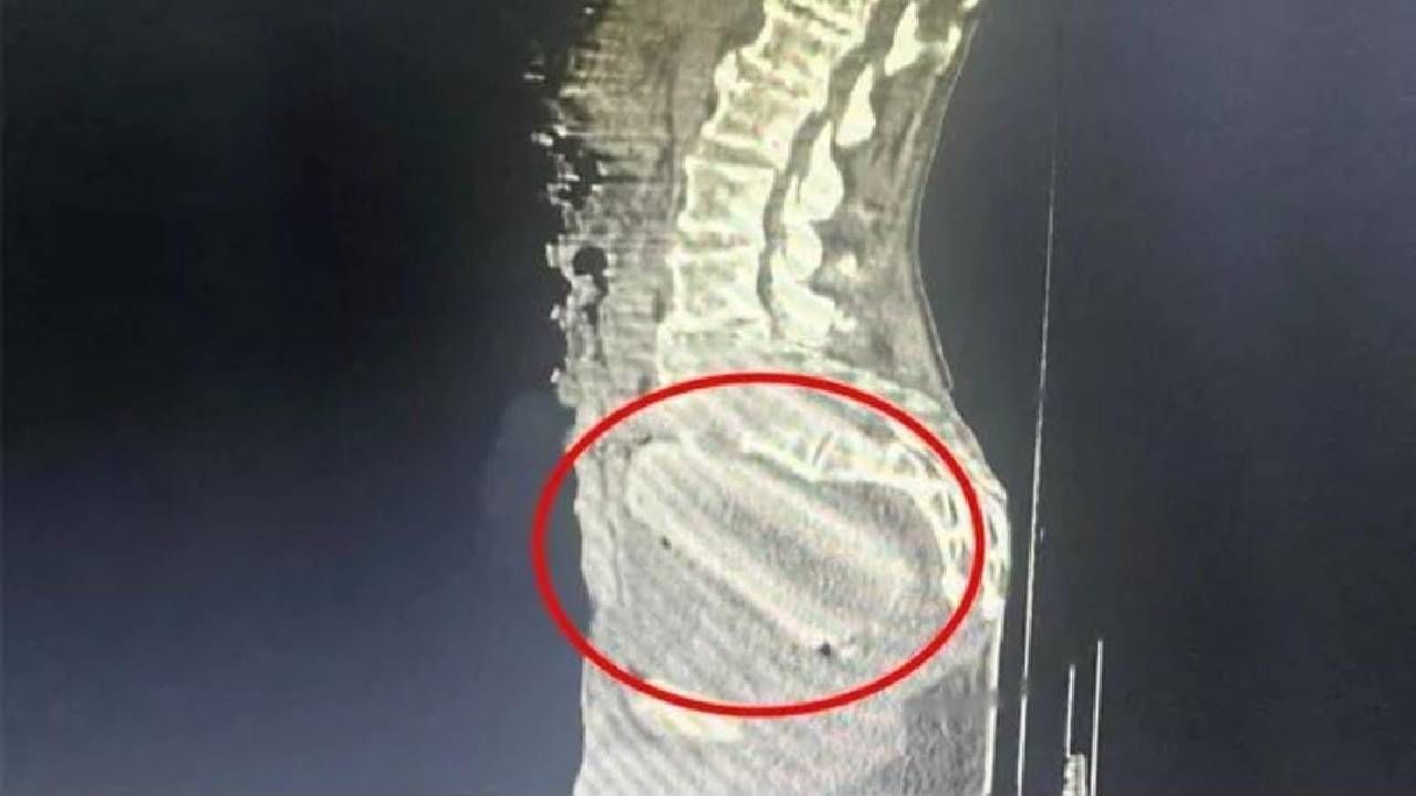 Viral: ಗುದದ್ವಾರದೊಳಗೆ ಮರಗೆಣಸು ತುರುಕಿದ 72 ಹರೆಯದ ಮುದುಕ; ಎಕ್ಸ್-ರೇ ರಿಪೋರ್ಟ್ ಕಂಡು ಶಾಕ್ ಆದ ವೈದ್ಯರು Viral: ಗುದದ್ವಾರದೊಳಗೆ ಮರಗೆಣಸು ತುರುಕಿದ 72 ಹರೆಯದ ಮುದುಕ; ಎಕ್ಸ್-ರೇ ರಿಪೋರ್ಟ್ ಕಂಡು ಶಾಕ್ ಆದ ವೈದ್ಯರು