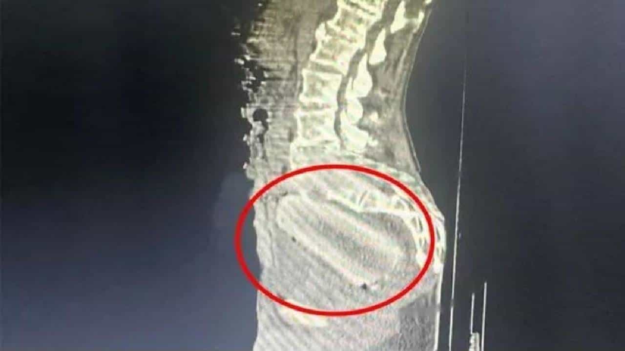 Viral: ಗುದದ್ವಾರದೊಳಗೆ ಮರಗೆಣಸು ತುರುಕಿದ 72 ಹರೆಯದ ಮುದುಕ; ಎಕ್ಸ್-ರೇ ರಿಪೋರ್ಟ್ ಕಂಡು ಶಾಕ್ ಆದ ವೈದ್ಯರು Viral: ಗುದದ್ವಾರದೊಳಗೆ ಮರಗೆಣಸು ತುರುಕಿದ 72 ಹರೆಯದ ಮುದುಕ; ಎಕ್ಸ್-ರೇ ರಿಪೋರ್ಟ್ ಕಂಡು ಶಾಕ್ ಆದ ವೈದ್ಯರು