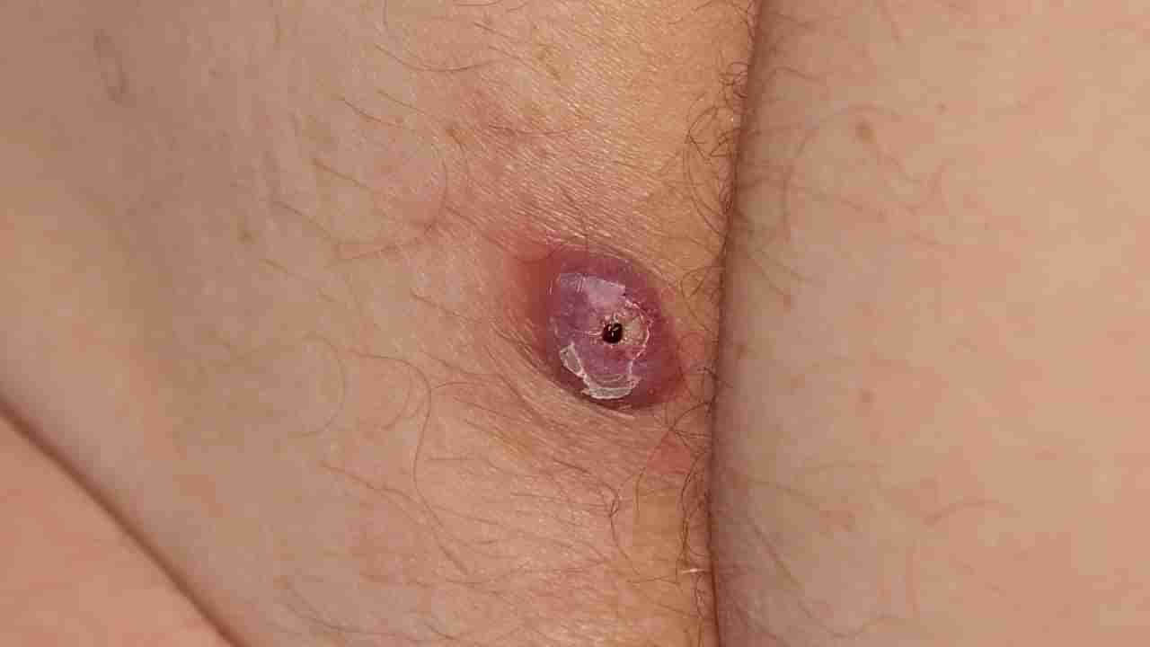 Home remedies: ಕುರು ಕಡಿಮೆ ಮಾಡಲು ಇಲ್ಲಿದೆ ಸಿಂಪಲ್ ಮನೆಮದ್ದು