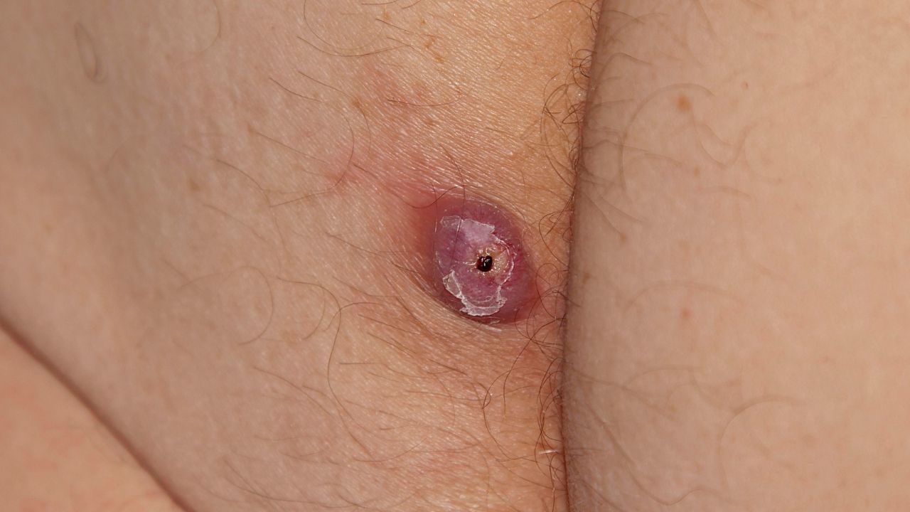 Home remedies: ಕುರು ಕಡಿಮೆ ಮಾಡಲು ಇಲ್ಲಿದೆ ಸಿಂಪಲ್ ಮನೆಮದ್ದು