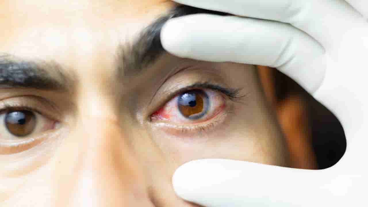 Eye Cancer: ಕಣ್ಣಿನ ಕ್ಯಾನ್ಸರ್ ಬಗ್ಗೆ ಕೇಳಿದ್ದೀರಾ? ಲಕ್ಷಣಗಳು ಹೇಗಿರುತ್ತವೆ ನೋಡಿ