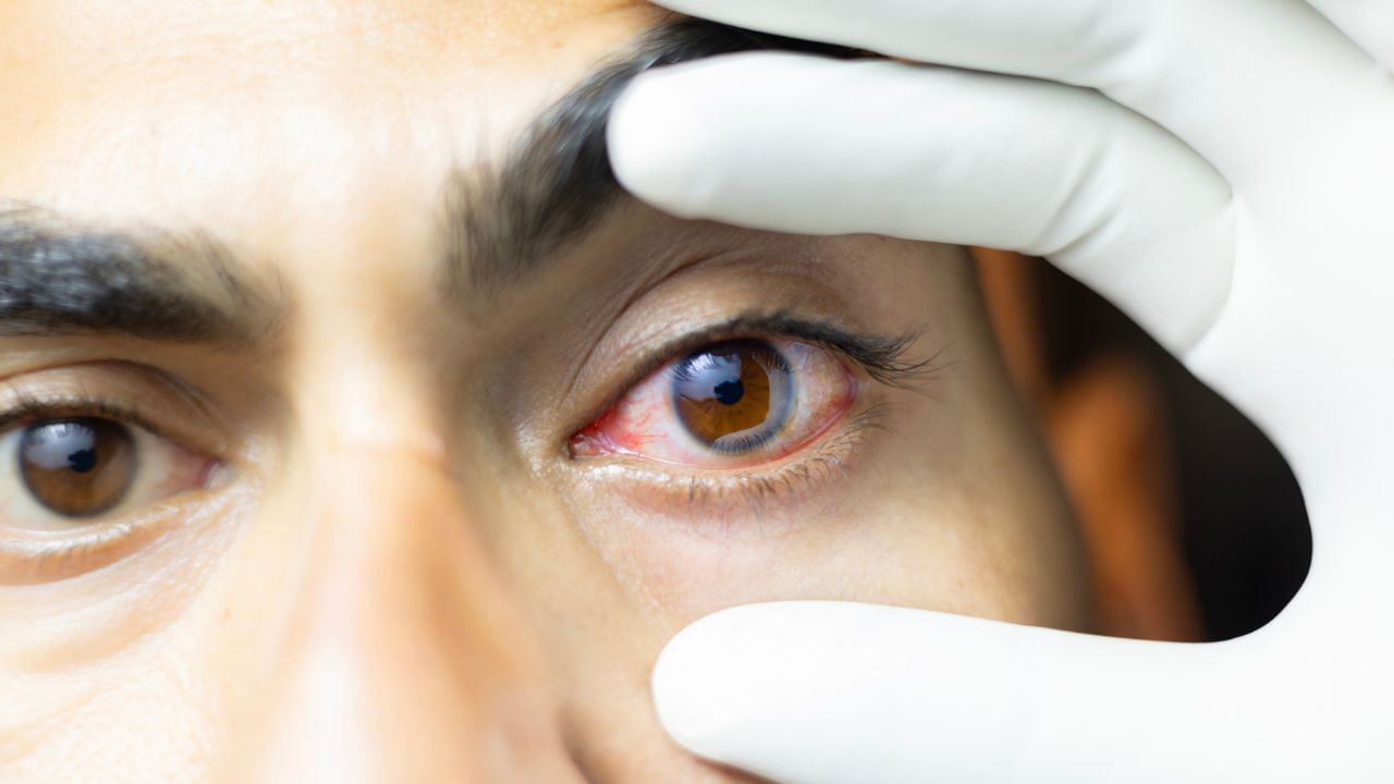 Eye Cancer: ಕಣ್ಣಿನ ಕ್ಯಾನ್ಸರ್ ಬಗ್ಗೆ ಕೇಳಿದ್ದೀರಾ? ಲಕ್ಷಣಗಳು ಹೇಗಿರುತ್ತವೆ ನೋಡಿ