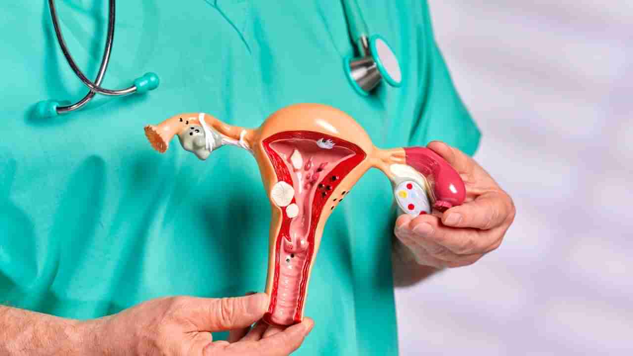 ಆರಂಭಿಕ ಹಂತದಲ್ಲಿರುವ ಅಂಡಾಶಯದ ಕ್ಯಾನ್ಸರ್ ಗುರುತಿಸುವುದು ಹೇಗೆ?